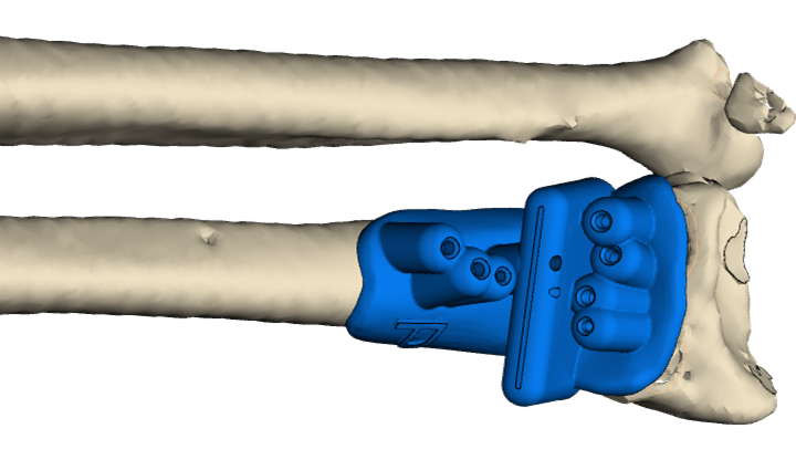 Guía quirúrgica a la medida impresa en 3D posicionada sobre el radio distal