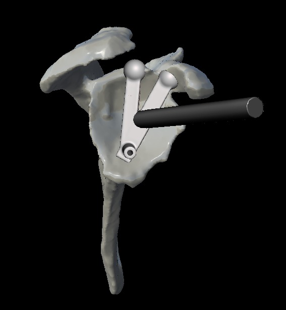 Guía quirúrgica a la medida diseñada sobre la reconstrucción 3D de una escápula