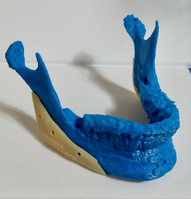 Modelo mandibular de perfil con la guía e implante a medida posicionados